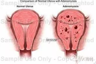 子宫腺肌病保守治疗无效怎么办?