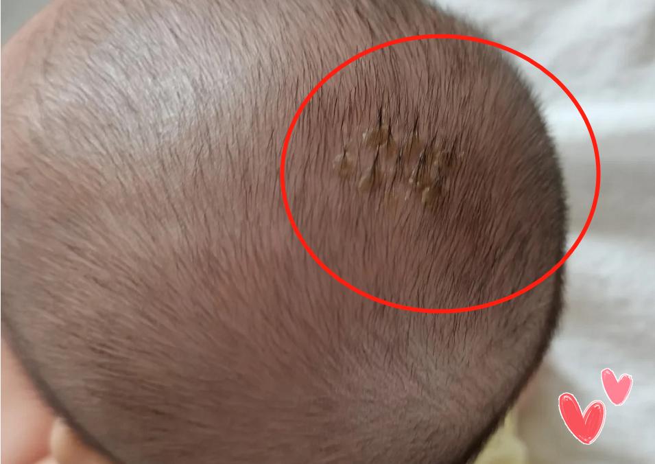 宝宝乳痂怎么去除,手贱扣痂会留印吗