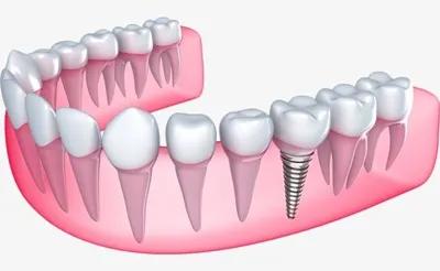 口腔种植专家为您解析,口腔种植牙科普