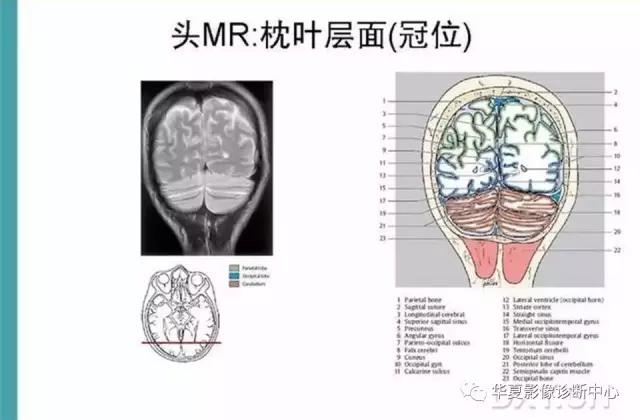 电子版头颅ct与mri断层解剖,头颅mri血管解剖与分段详解