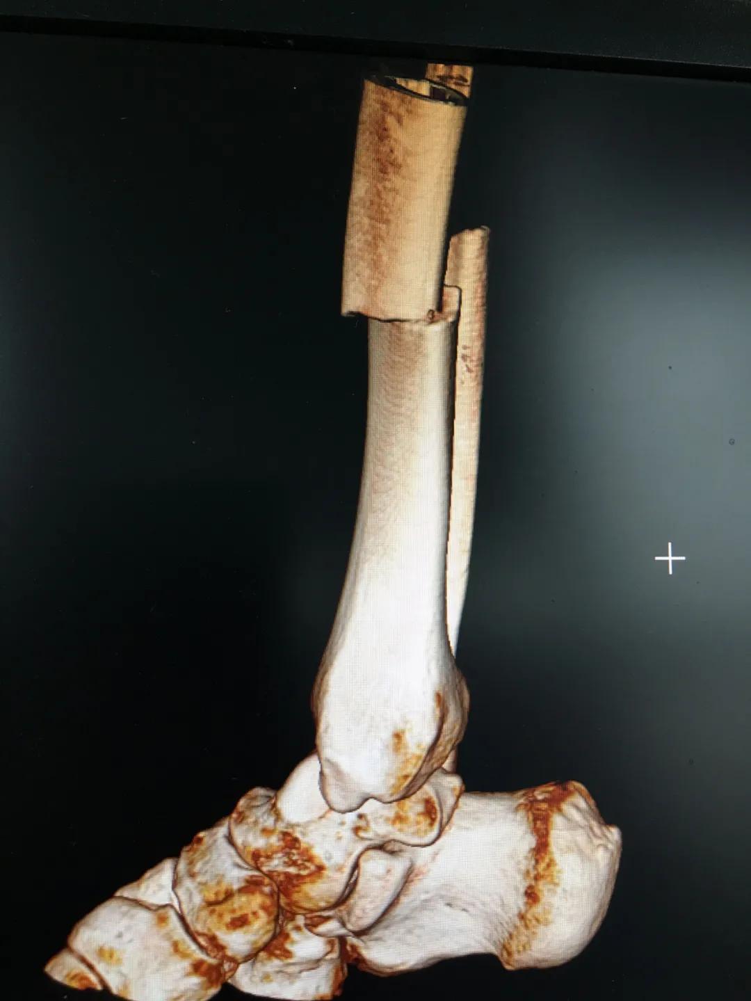 小腿骨断成三截了还能恢复吗,小腿断了三截能好彻底吗