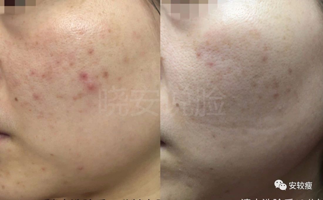 外油内干敏感痘肌怎么护肤,30岁油皮痘痘敏感肌怎么改善