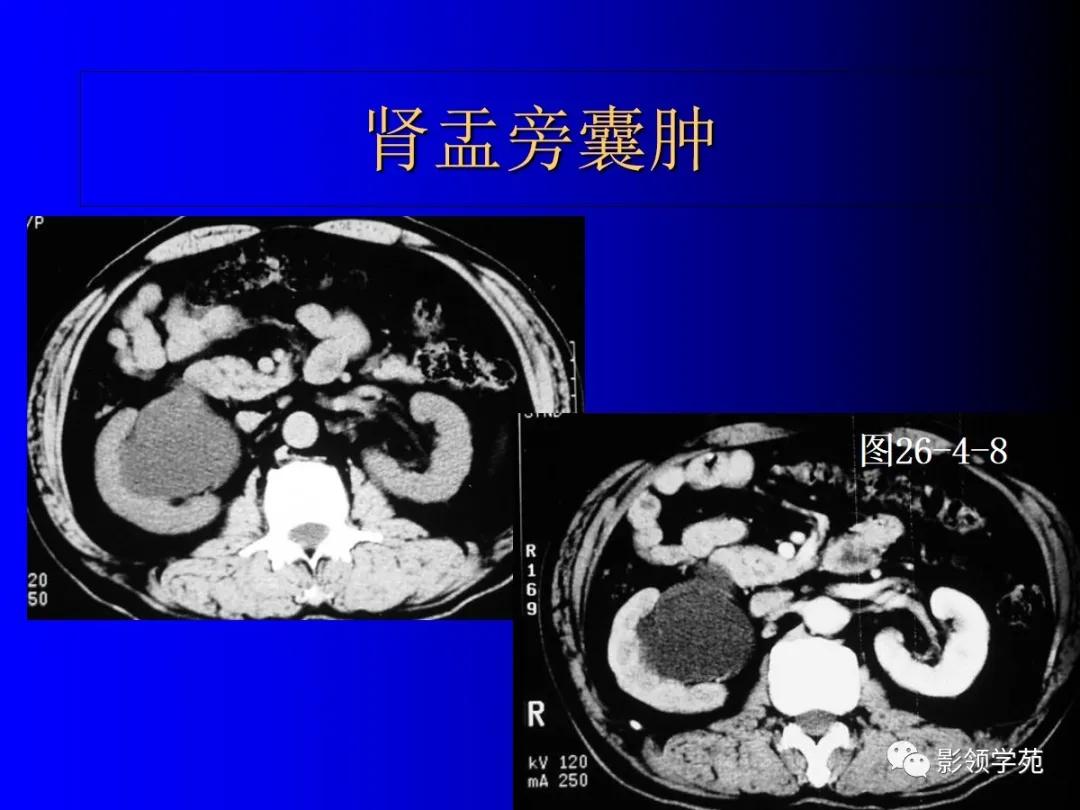 肾脏囊性肿块的影像学特点,肾脏典型病理图片及解析