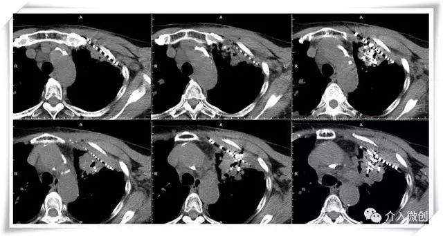 肺转移瘤消融能达到根治效果吗,肺转移瘤中医治疗