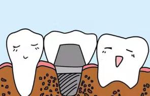 做种植牙要一直张嘴吗,做种植牙需要磨牙吗