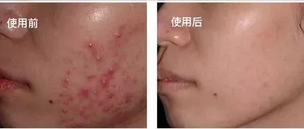 抗痘抑菌凝胶,祥顺比尔霍夫抑菌凝胶治理皮癣