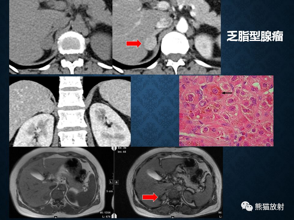 纵隔和肾上腺恶性肿瘤,纵隔性肿瘤位置图