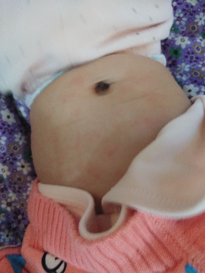 宝宝反复湿疹要崩溃了,湿疹宝宝一定是过敏体质吗