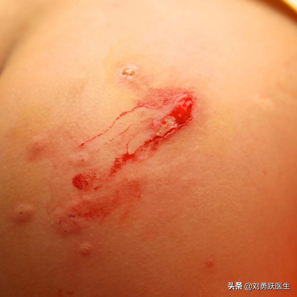 化脓性骨髓炎的症状和治疗方法,野蛮治疗