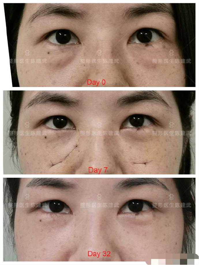 去眼袋泪沟医美方法,想了解一下去眼袋的最佳方法