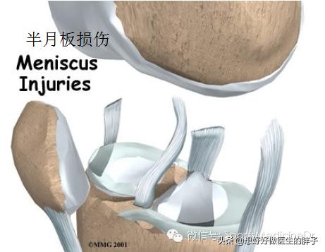 半月板损伤通常是单膝还是双膝,你知道半月板是什么吗