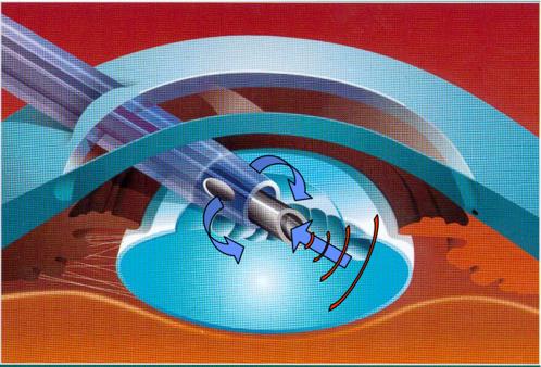 为什么有人说白内障术后会复发,白内障术后复发的原因有哪些