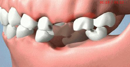 缺了一颗牙不影响吃饭,缺了一颗牙不补