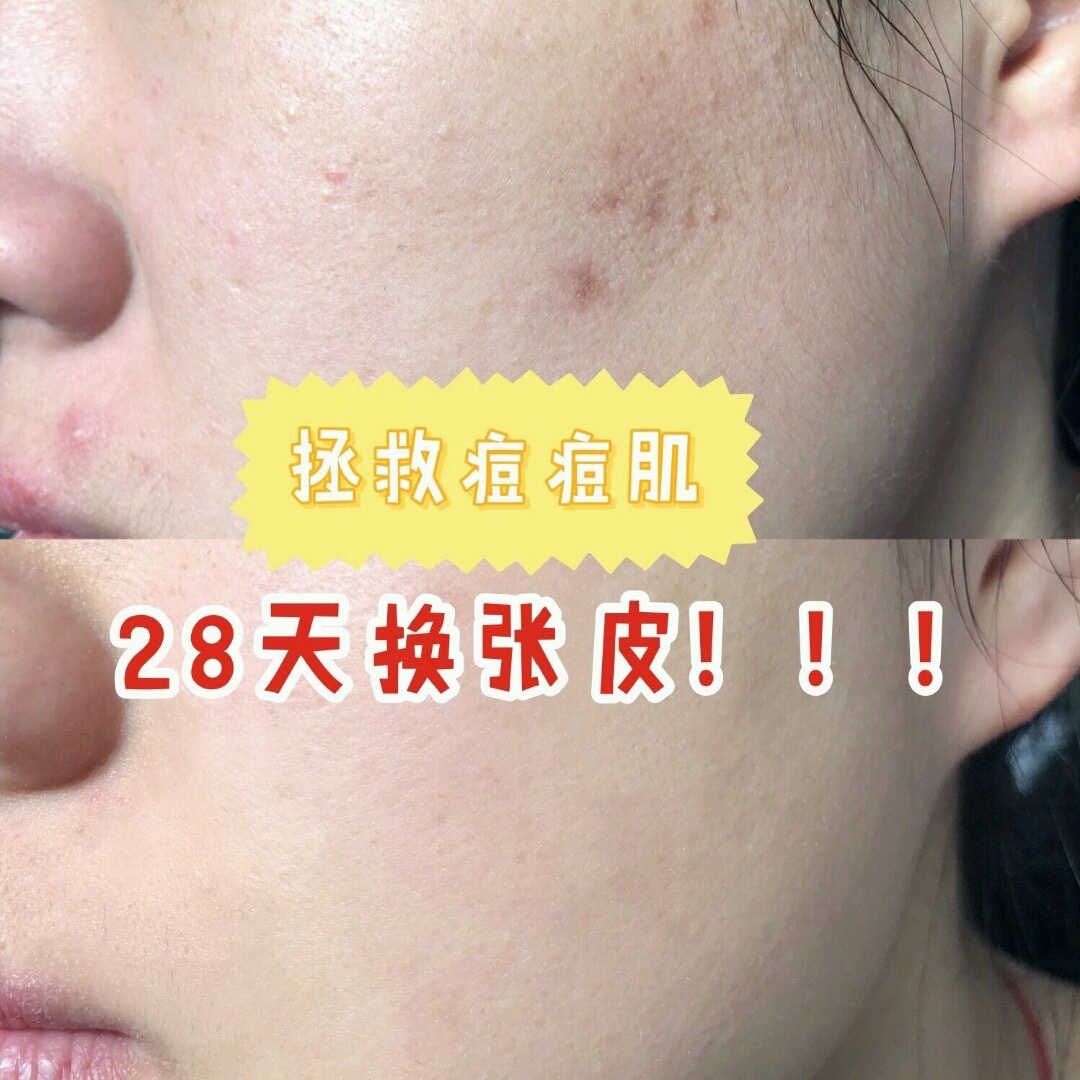 油痘肌祛痘膏推荐,祛痘痘膏哪个牌子最好