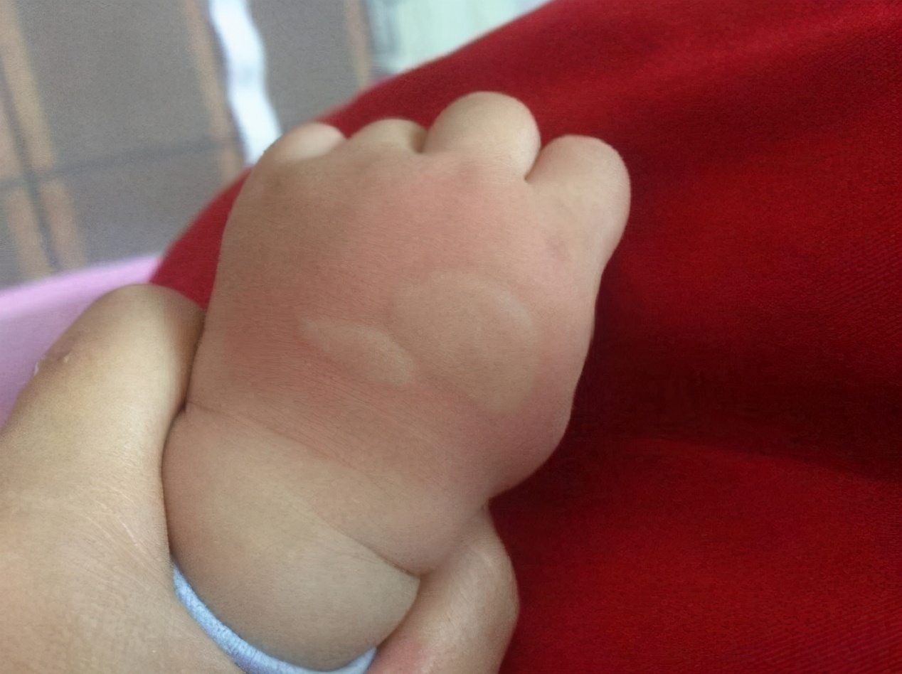 蚊子叮人对血型有要求,蚊子叮人要分血型吗