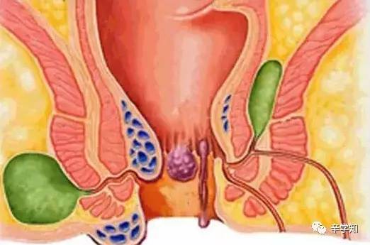 轻微痔疮怎么预防推荐手术,痔疮手术害怕怎么办