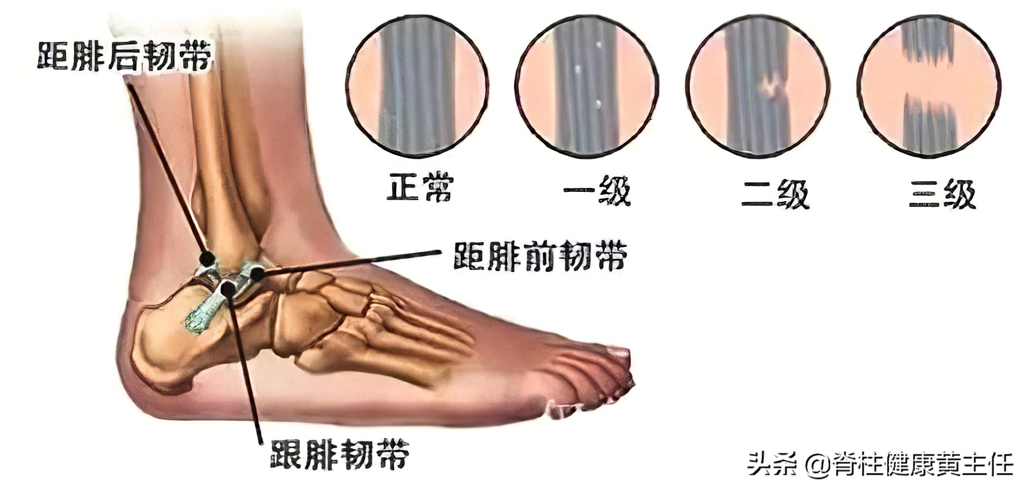 踝关节扭伤脱位手法复位视频,踝关节扭伤手法复位多久可以运动