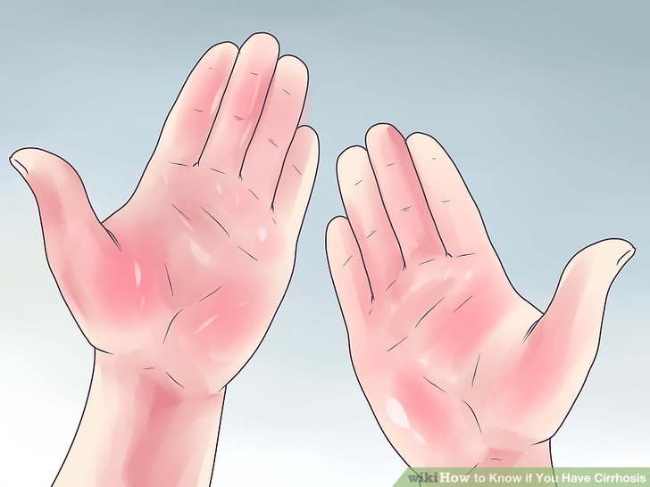 有肝掌蜘蛛痣得肝硬化的几率大吗,有肝掌和蜘蛛痣一定是肝硬化么