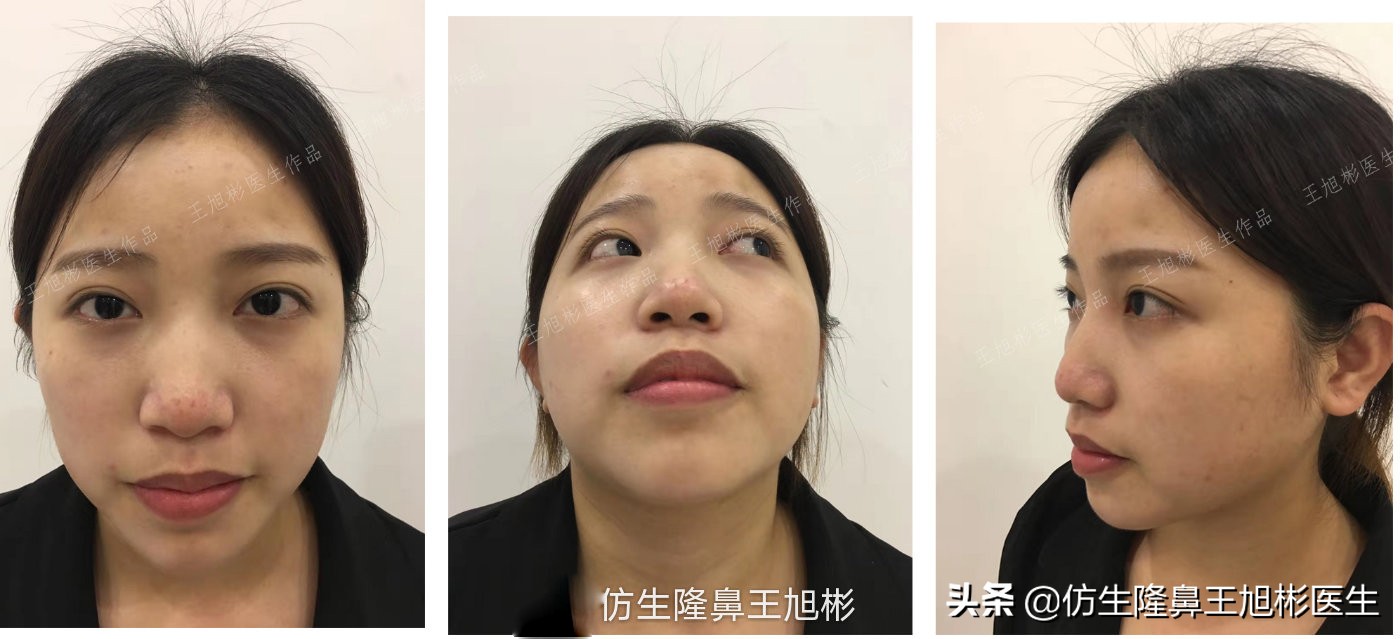 手术鼻头增厚能用什么方法弄,大鼻头高鼻梁缩小手术案例