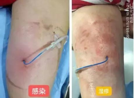 护士picc导管维护,护士picc相关知识薄弱