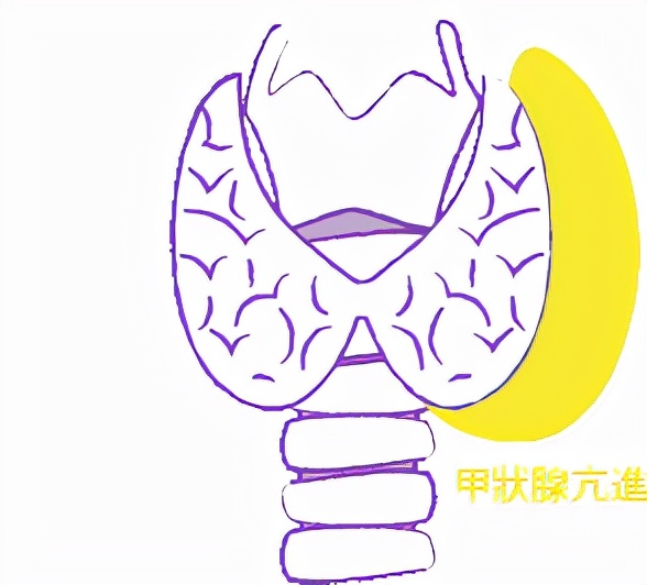 年轻人甲状腺影像是什么样子,甲状腺结节是什么样子