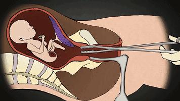 医生揭露：900多万例人流术背后，那些血淋淋的事实...