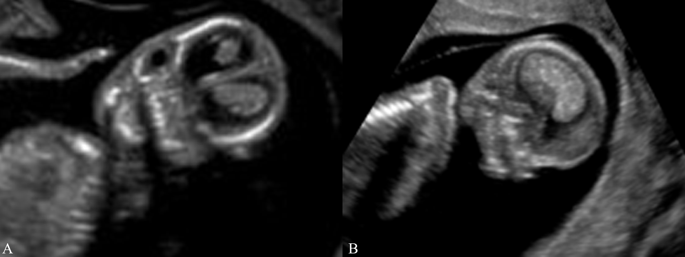 做四维彩超时胎儿动态视频,孕早期超声怎么诊断胚胎发育不良