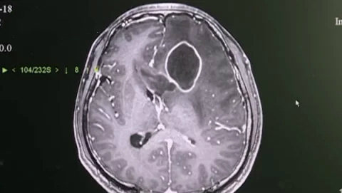 脑脓肿武汉小伙,年轻小伙脸上有个脓包