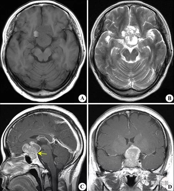 脑部脓肿怎么治疗,多发性脑脓肿能自愈吗