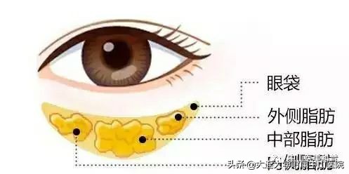 你有没有被自己的眼袋困扰过,关于眼袋的科普在这里