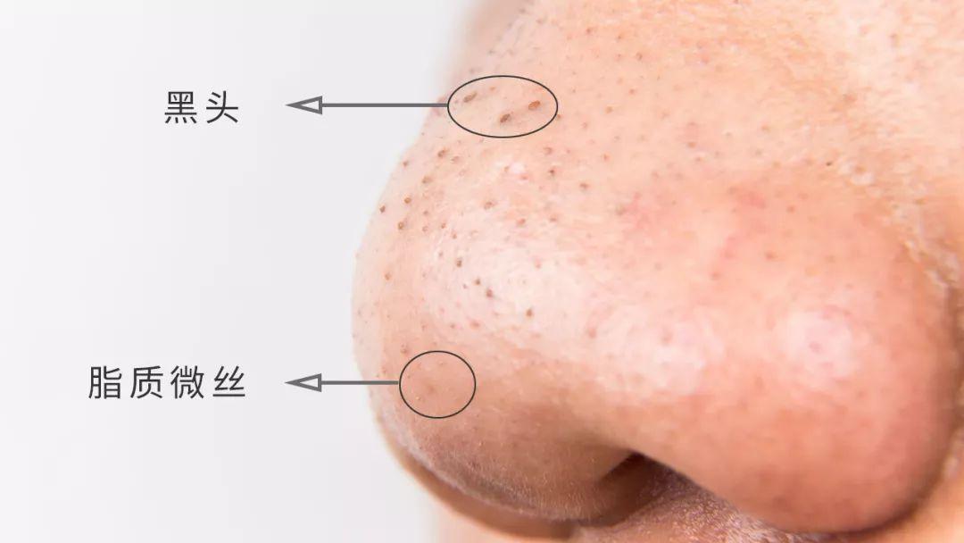 这才是真正祛黑头正确方法,真正好用的祛黑头方法