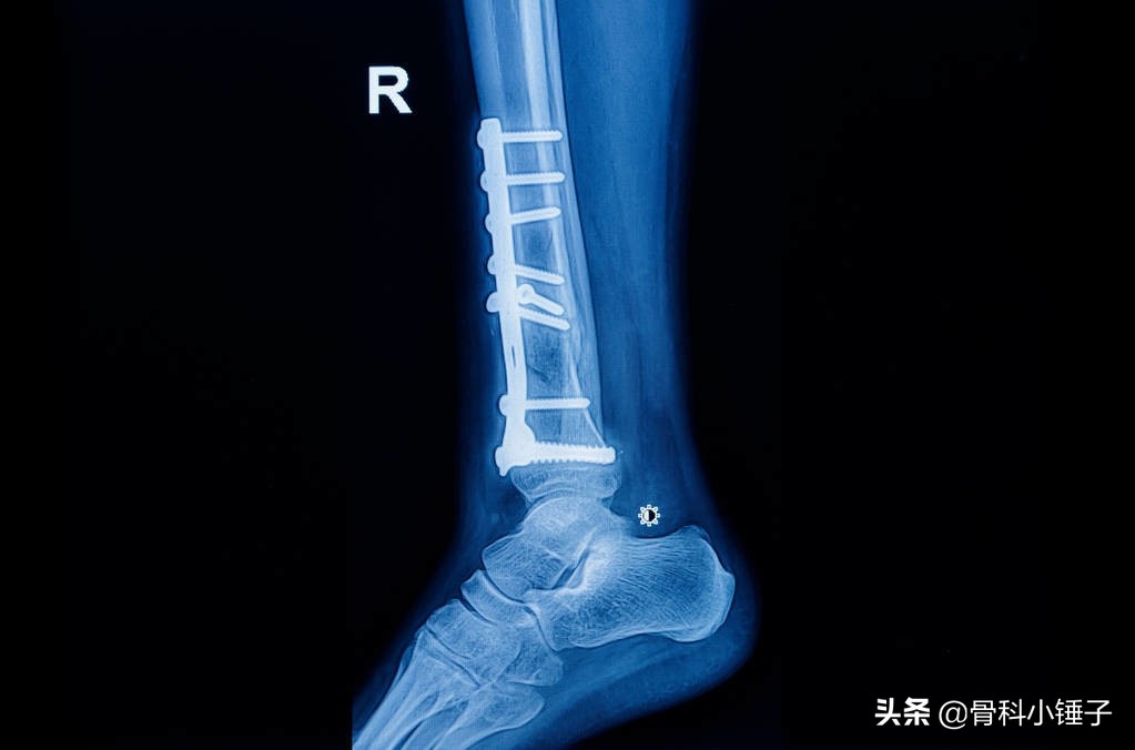 踝关节骨折保守治疗愈合全过程,踝关节骨折的护理诊断及措施