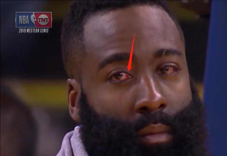 19年季后赛库里手指骨折后首秀,库里左手手指变形图片
