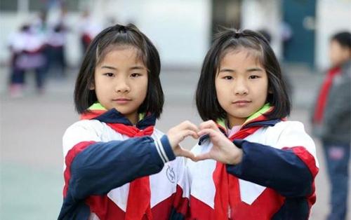 国内首例连体双胞胎,坐骨连体双胞胎女孩现状