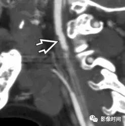 双侧颈动脉鞘间隙多发小淋巴结影,双侧颈动脉间隙多软组织密度结节
