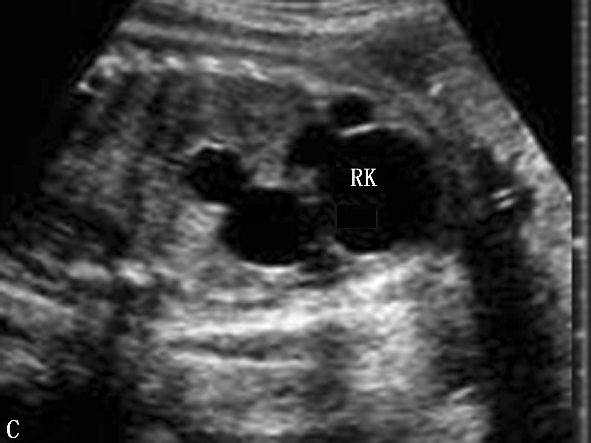 泌尿彩超全过程3d,胎儿肾积水要不要看泌尿科