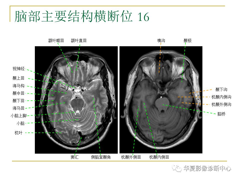 中国人脑立体定向mri应用解剖图谱,脑mri示意图