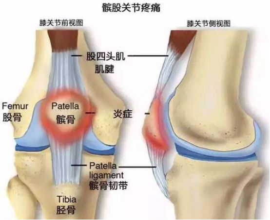 膝盖前面的韧带疼痛怎么回事,膝盖疼痛别发愁了