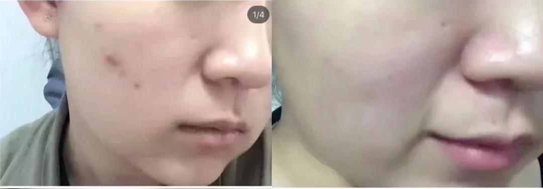 平价淡斑美白小灯泡,神仙水小灯泡精华淡斑