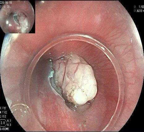 贲门处见隆起性病变,贲门高级别瘤变esd术后不能吃什么