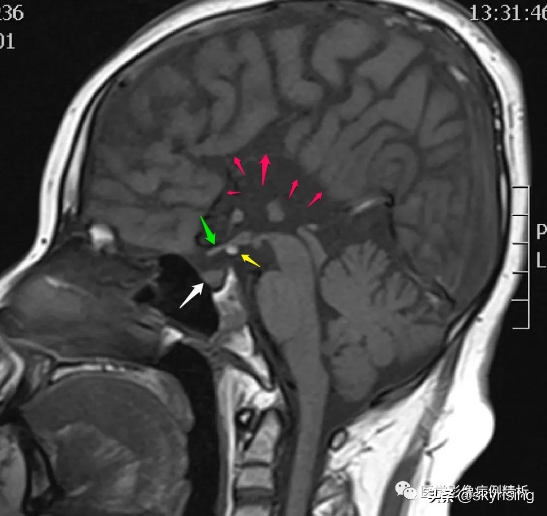 半叶全前脑畸形,无叶型前脑无裂畸形超声表现