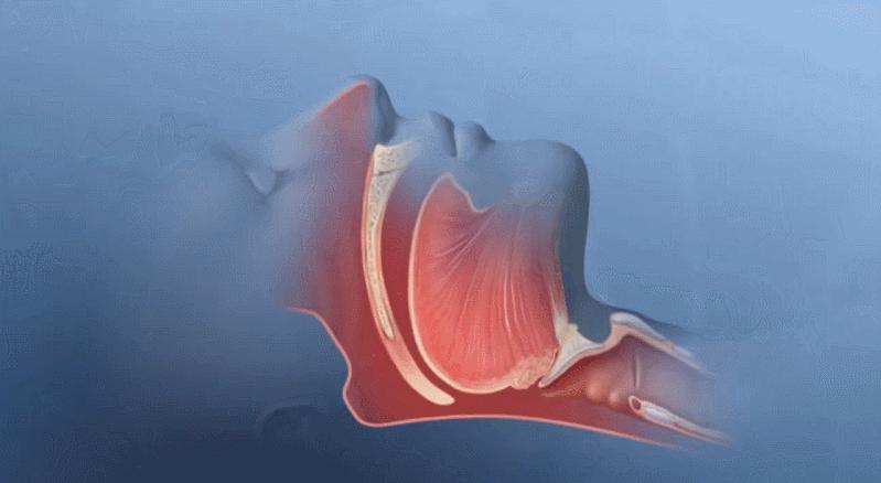 呼吸机治疗呼吸暂停原理,睡眠呼吸暂停综合征呼吸机参数