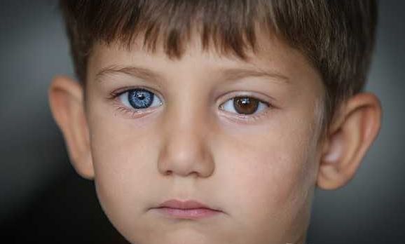 俩男孩各自长着一对一蓝一棕眼珠网友称赞连连却不知这是罕见病