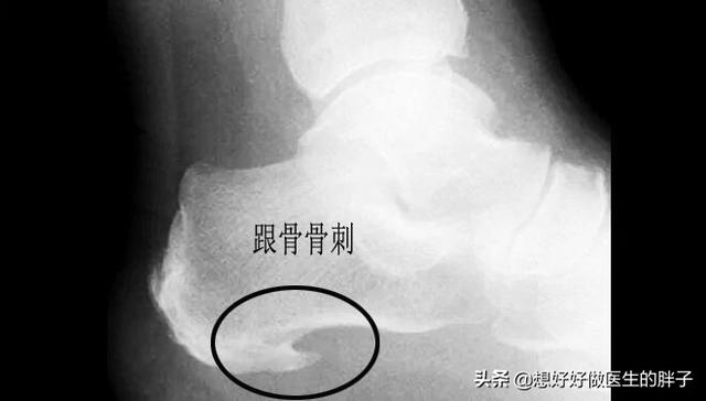 跑步脚后跟轻微疼痛可以继续跑么,时间久了不跑步突然跑步脚后跟疼