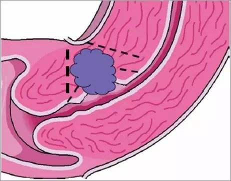 剖腹产一笑都疼是怎么回事,剖腹产到底是什么感受
