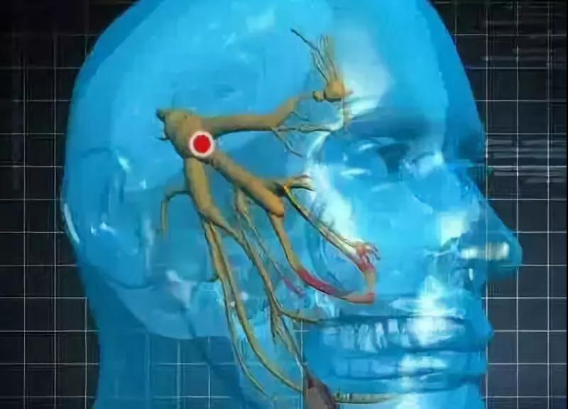 关于三叉神经痛你应该知道有哪些,持续三叉神经痛的最佳解决办法