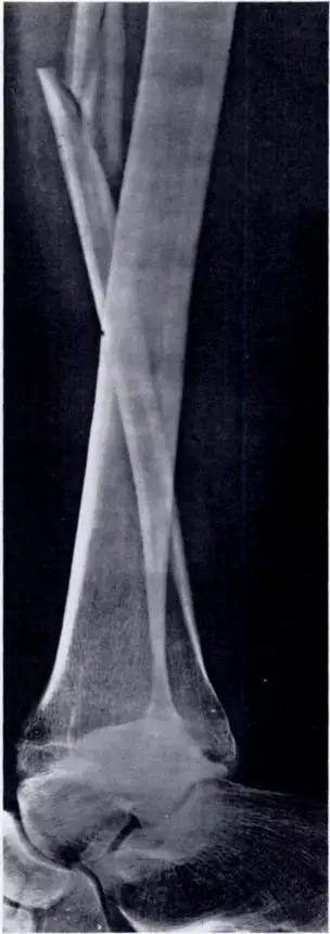 几种严重骨折医学名称,常见的骨折有哪些名称