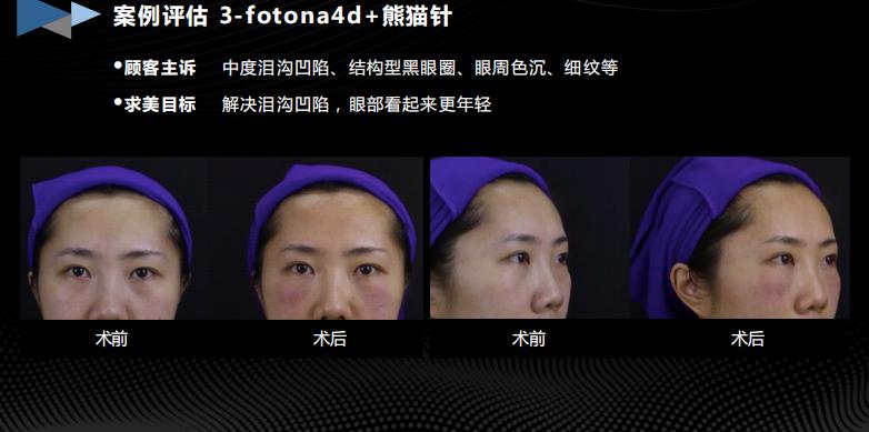 胶生灌养眼周抗衰是什么产品?