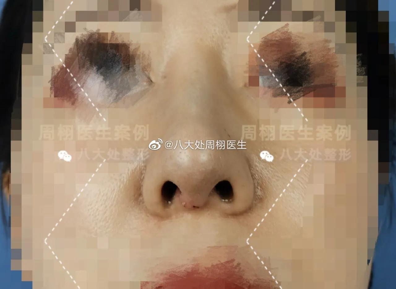 鼻整形手术,鼻整形术