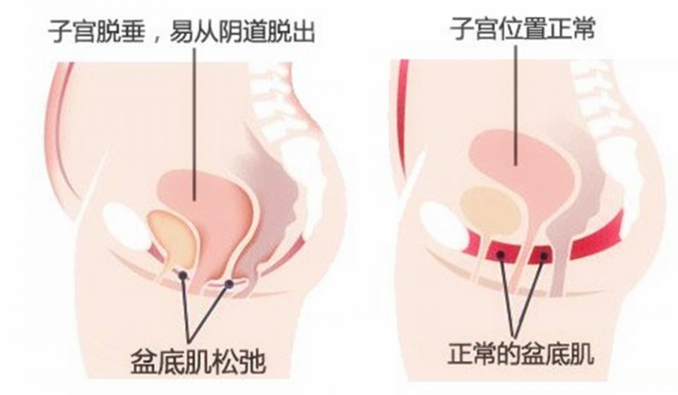 女性隐私部位“松弛”,影响夫妻感情,可能与这“1少1多”有关